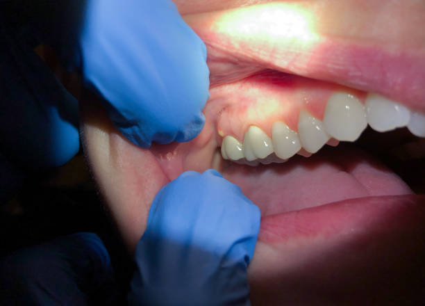 Best Dental Abscess Treatment in Shamokin, PA